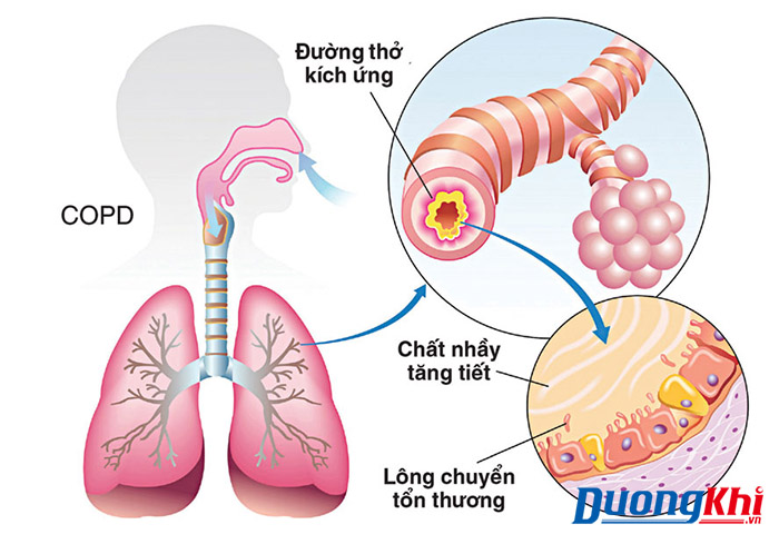 bệnh phổi tắc nghẽn mãn tính
