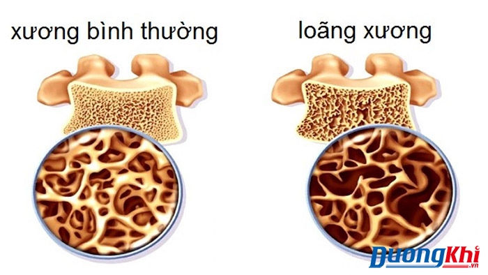 ô nhiễm không khí gây bệnh loãng xương