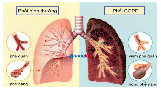 ô nhiễm không khí gây viêm phế quản