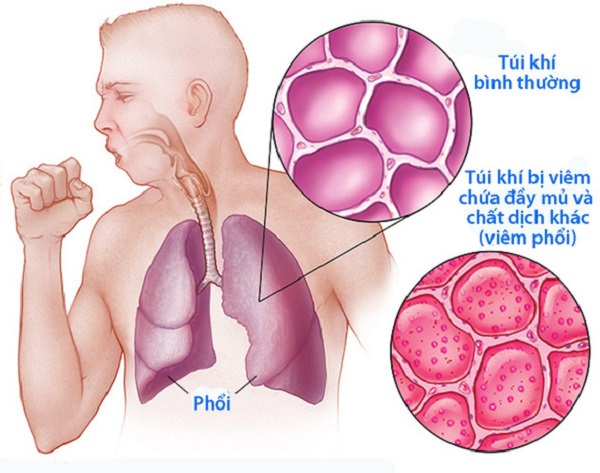 ô nhiễm không khí gây viêm phế quản