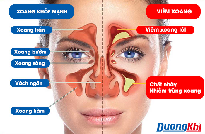bệnh viêm xoang